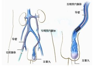 男性精索静脉曲张的原因是什么？